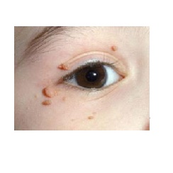 Hình ảnh bệnh nhân bị Hạt cơm ở mặt (mụn cơm, mụn cóc) do nhiễm Human Papilloma Virus